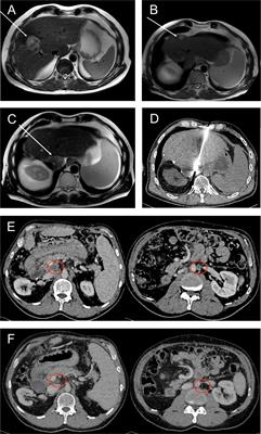 Case Report: Sustained complete remission on combination therapy with olaparib and pembrolizumab in BRCA2-mutated and PD-L1-positive metastatic cholangiocarcinoma after platinum derivate